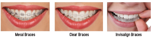 Types of braces for adults