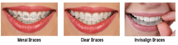 Average price shop for braces