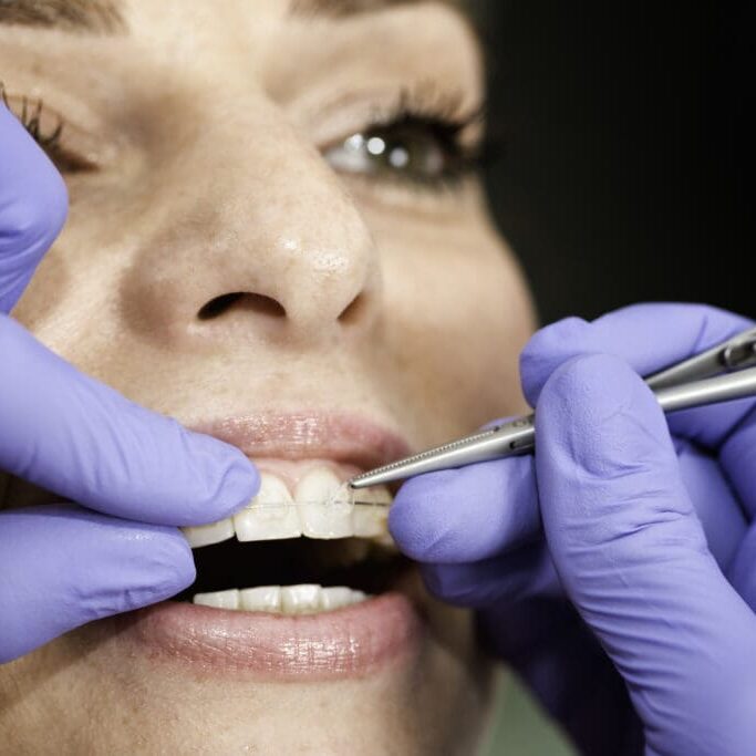 Invisible ceramic braces Orthodontist fixing invisible ceramic braces