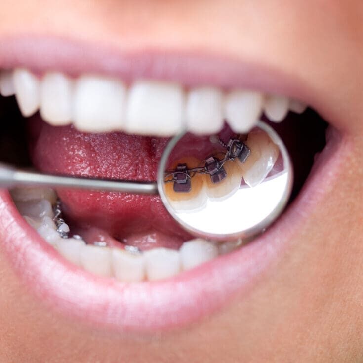 Dental mirror showing lingual braces Female patient showing her invisible lingual braces braces on dental mirror